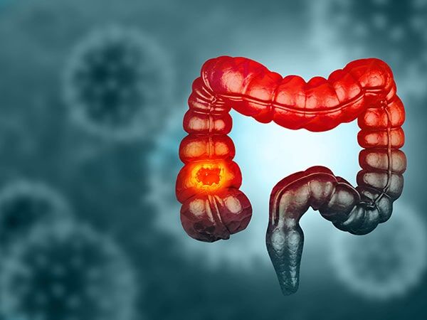Ghaziabad, Health, Find Colon Cancer Treatment In Noida With Dr. Manish Singhal