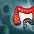 Find Colon Cancer Treatment In Noida With Dr. Manish Singhal