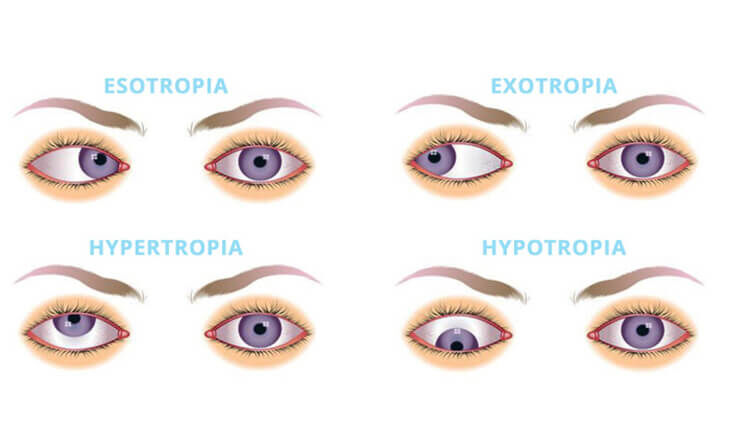 New Delhi, Health, Squint Eye Surgery In Delhi - Dr Anisha Gupta