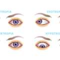 Squint Eye Surgery In Delhi - Dr Anisha Gupta