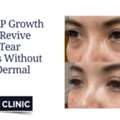 How PRP Growth Factors Revive Hollow Tear Troughs Without Heavy Dermal Fillers
