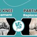 Unsure About Knee Replacement Surgery? | Dr. Divyesh Bukalsaria