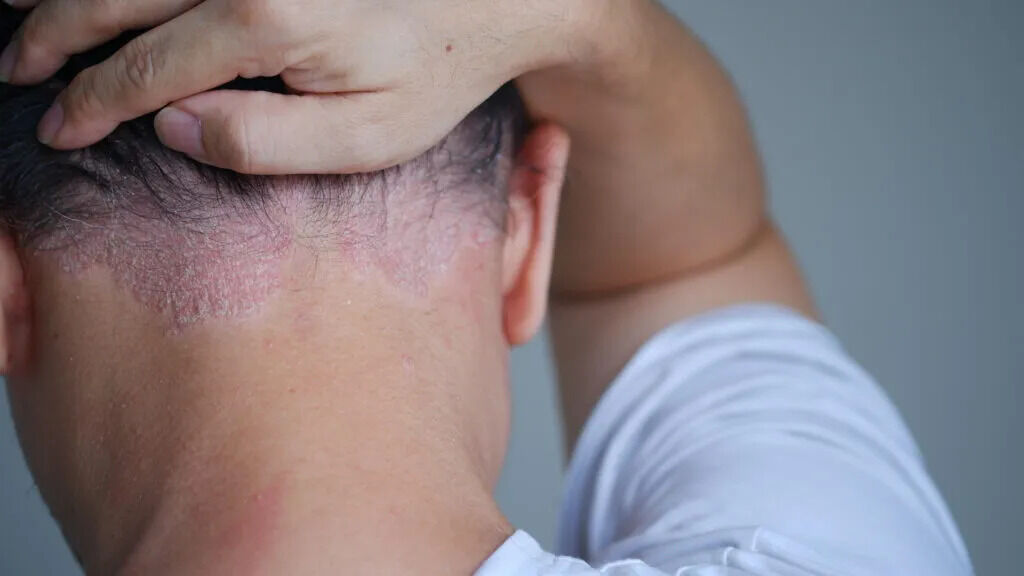 New York, Health, Psoriasis Private Treatment In Southern California