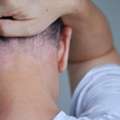Psoriasis Private Treatment In Southern California