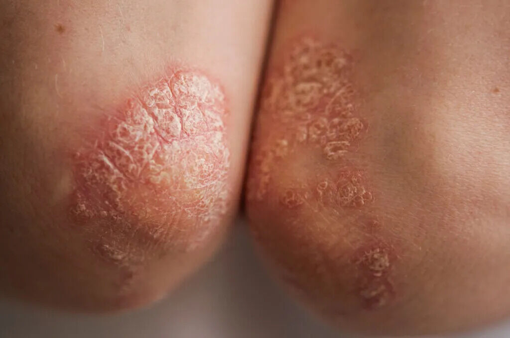 New York, Health, Psoriasis Private Treatment In Southern California