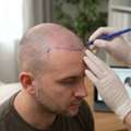 Worried Your Hair Transplant Will Look Unnatural? Dr. Haror&rsquo;s Wellness Gets The Hairline R
