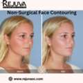 Non-surgical Face Contouring Newport Beach: Know Your Options