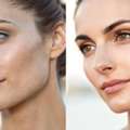 Jawline Clenching Or Sagging Jowls? How Masseter Botox & RF Microneedling