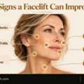 Facelift In Dubai | Facelift Surgery In Dubai | Dr Adel Quttainah