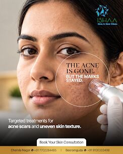 Telangana, Health, Scar Treatment In Beeramguda | Ishaa Skin & Hair Clinic