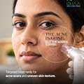 Scar Treatment In Beeramguda | Ishaa Skin & Hair Clinic