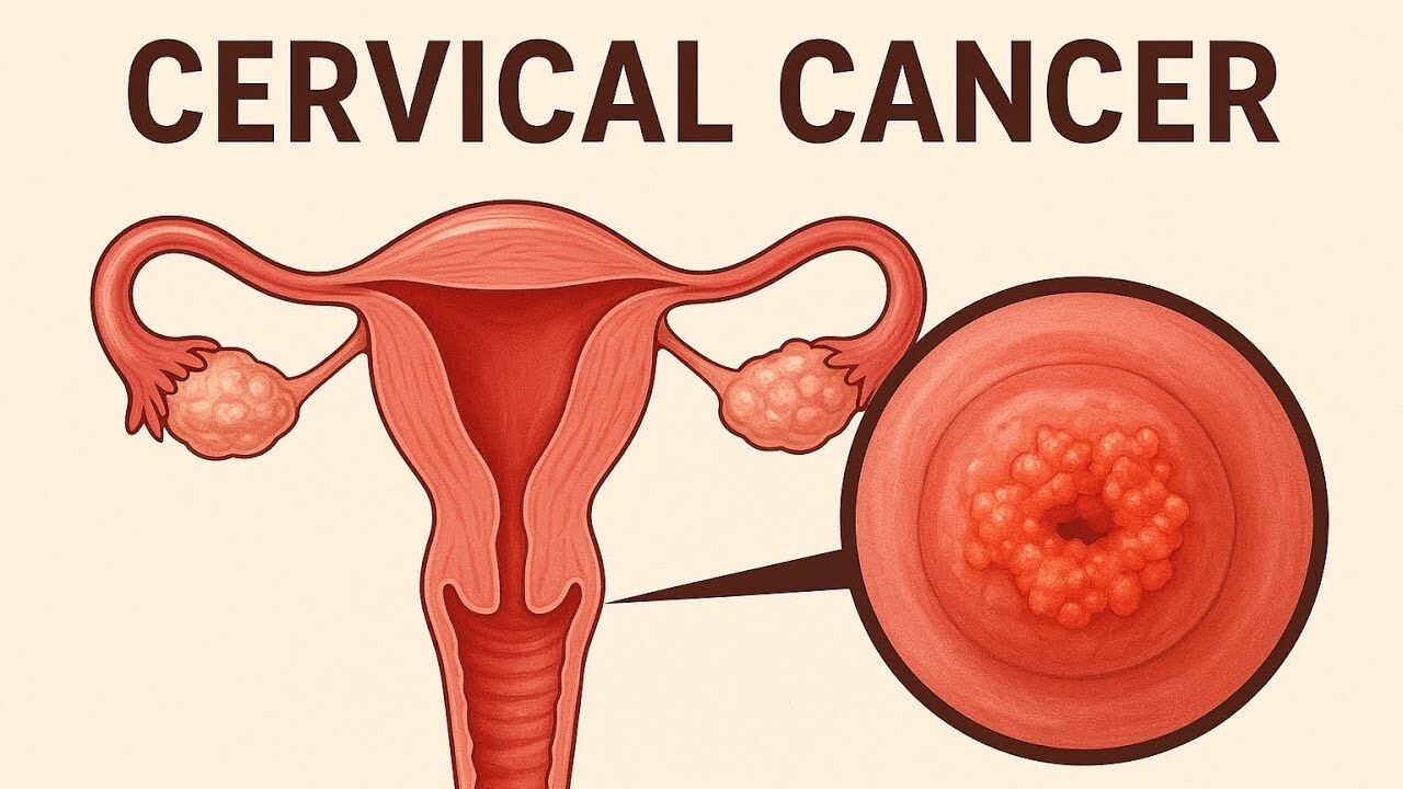 Ghaziabad, Health, Advanced Cervical Cancer Treatment In Noida | Dr. Manish Singhal
