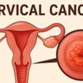 Advanced Cervical Cancer Treatment In Noida | Dr. Manish Singhal