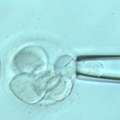 Discover Assisted Embryo Hatching In Delhi At Fertylity IVF