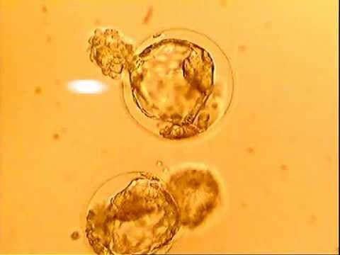 New Delhi, Health, Blastocyst Transfer In Delhi With Personalized IVF Guidance | Fertylity IVF