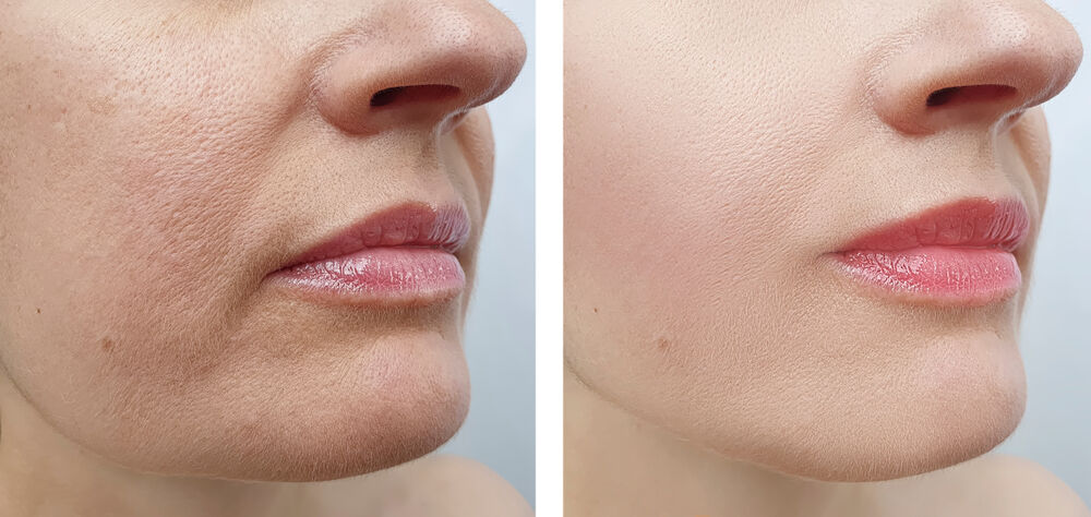 New York, Beautician, PRX Peel In Aventura, FL | Skin Rejuvenation Experts