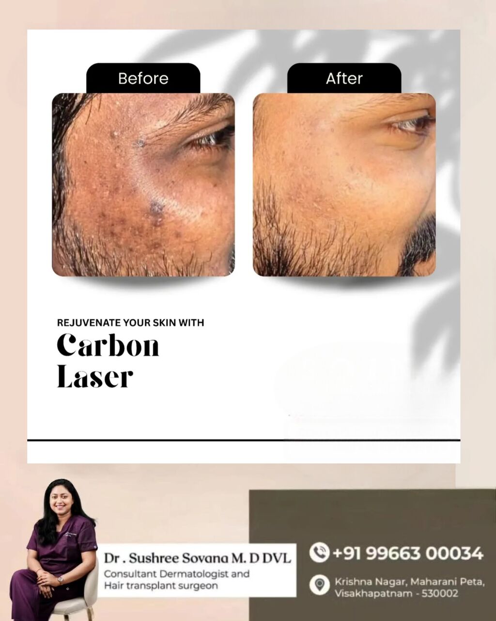Visakhapatnam, Health, Laser Carbon Facial Game Changer For Your Skin- Dr Sushree Sovana
