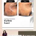 Laser Carbon Facial Game Changer For Your Skin- Dr Sushree Sovana