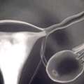 Female Infertility Treatment In Delhi With Expert Fertylity IVF Care