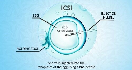 New Delhi, Health, Modern ICSI Treatment In Delhi | Fertylity IVF Care