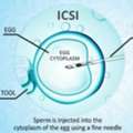 Modern ICSI Treatment In Delhi | Fertylity IVF Care