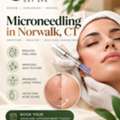 Get Smooth Skin With Microneedling In Norwalk, CT
