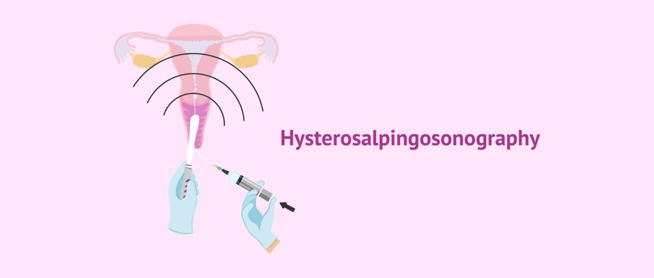 New Delhi, Health, Hysterosalpingography In Delhi | Fertylity IVF Fertility Experts