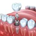 Your Trusted Dentist For Dental Implants & Complete Family Dentistry