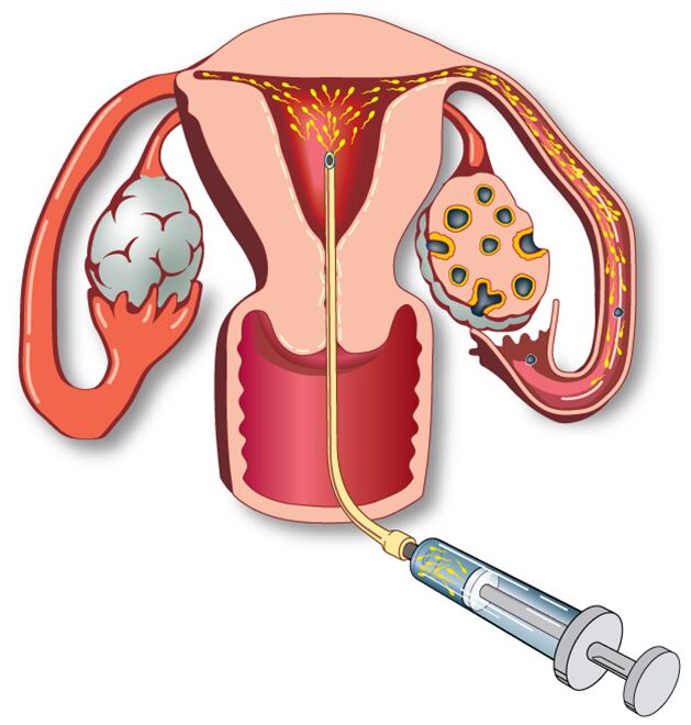 New Delhi, Health, Trusted Intrauterine Insemination In Delhi At Fertylity IVF