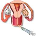 Trusted Intrauterine Insemination In Delhi At Fertylity IVF