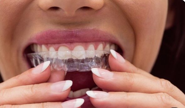 Mumbai, Health, How Invisible Braces In Borivali Help Correct Misaligned Teeth
