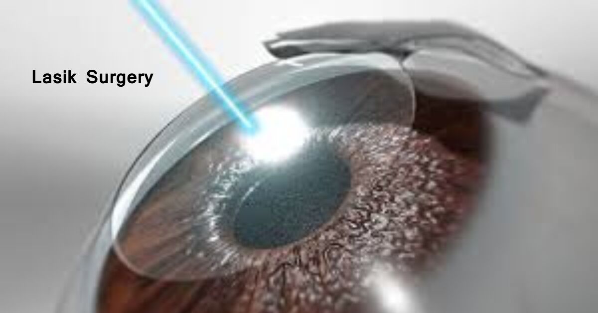 New Delhi, Health, LASIK Eye Surgery In Noida: Everything You Need To Know