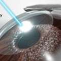 LASIK Eye Surgery In Noida: Everything You Need To Know