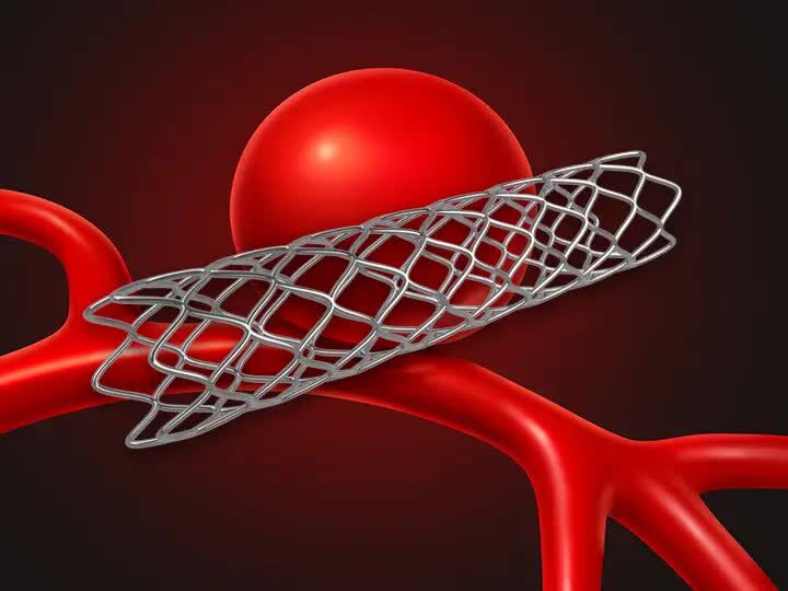 Ahmedabad, Health, Exploring Coiling Aneurysm Procedure For Better Care?