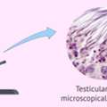 Sperm/Testicular/Tissue In Delhi | Fertylity IVF Experts