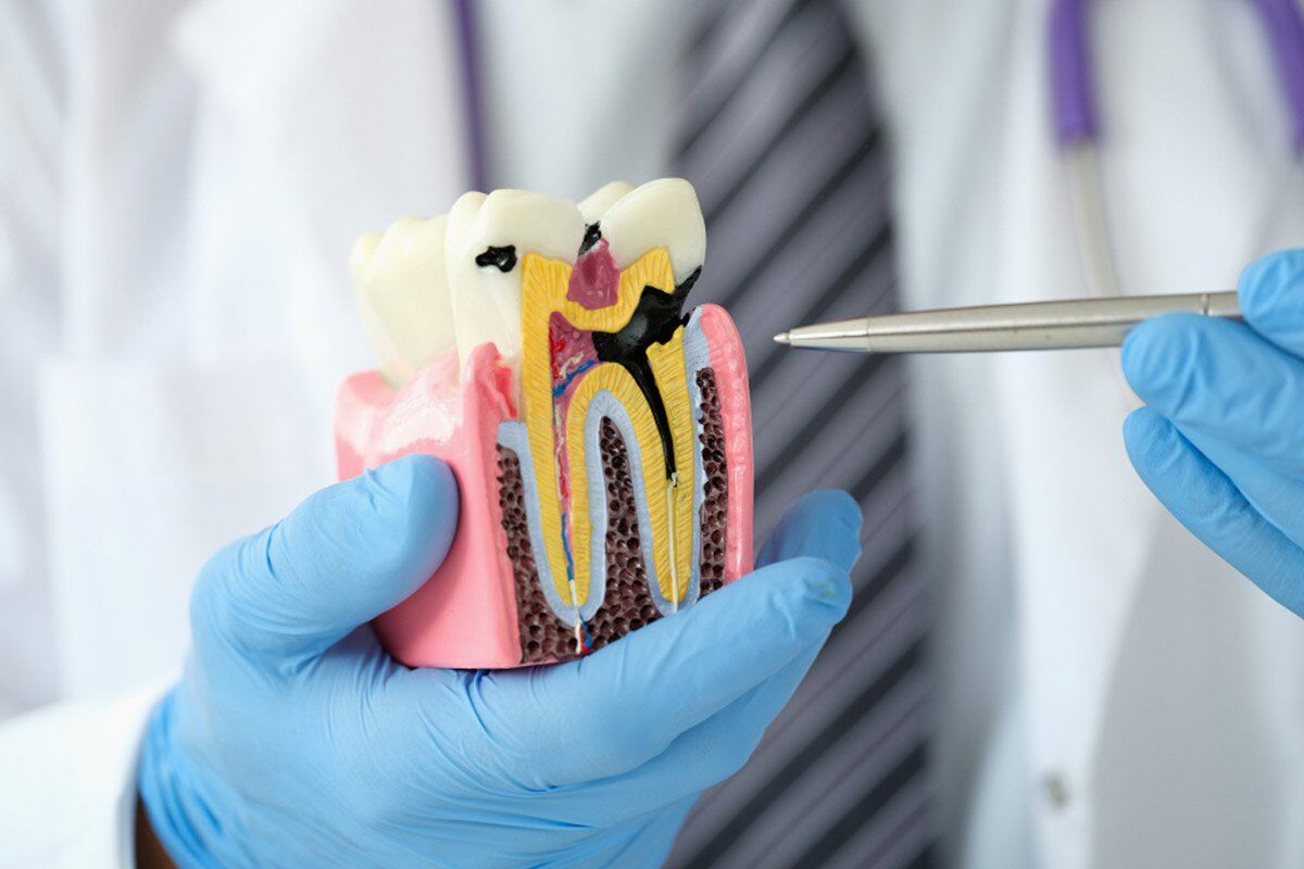 Madurai, Dental, Root Canal Treatment In Madurai