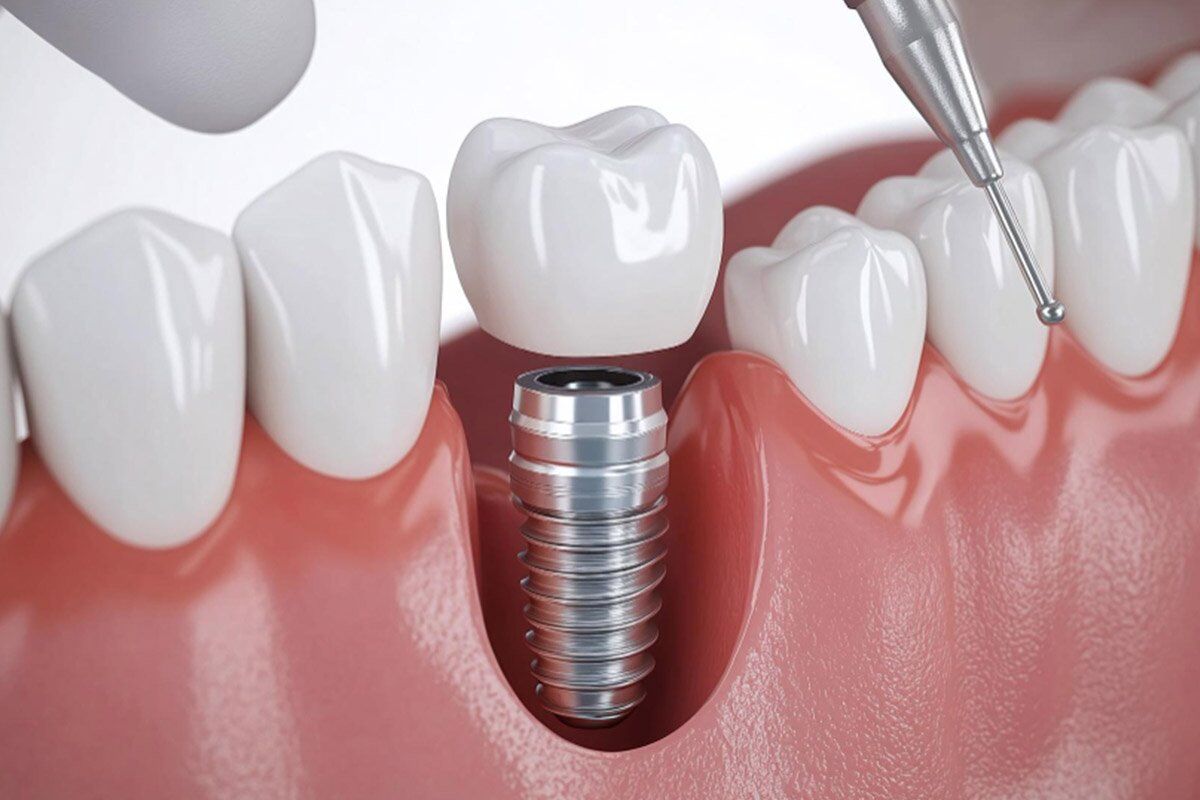 Madurai, Dental, Dental Implants In Madurai