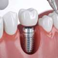 Dental Implants In Madurai