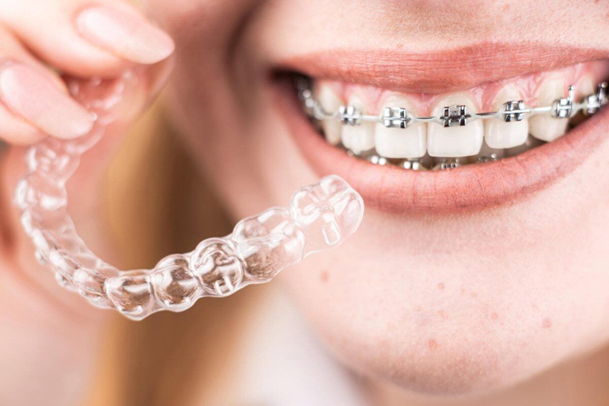Madurai, Dental, Best Invisalign Dentist In Madurai