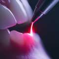 Laser Dentistry In Madurai