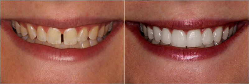 New York, Dental, Smile Makeover In Dublin, Ohio &ndash; Dublin Metro Dental