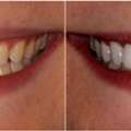Smile Makeover In Dublin, Ohio – Dublin Metro Dental