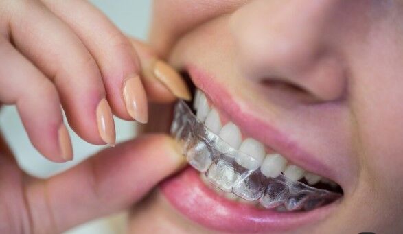 Mumbai, Health, How To Choose The Best Aligners In Borivali For Your Smile