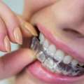 How To Choose The Best Aligners In Borivali For Your Smile