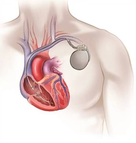 Dubai, Health, Find Internal Cardiac Defibrillator In UAE At TheHeart.ae