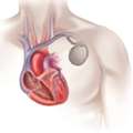 Find Internal Cardiac Defibrillator In UAE At TheHeart.ae