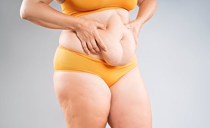 New Delhi, Health, Tummy Tuck Surgery In Delhi - Dr Rajat Gupta