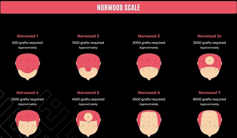London, Beautician, Understand Your Hair Loss! Explore The Norwood Scale Today