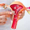 Uterine Fibroids Treatment In Delhi