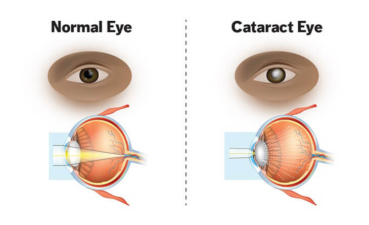 New Delhi, Health, Cataract Eye Surgery In Delhi - Dr Anisha Gupta